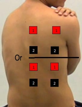 Identify the correct pad placement to administer interferential currents on the back. A)    B)    C)    D)    E)    