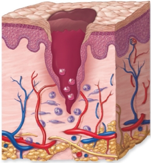 <strong>Based on the figure, what is occurring during this process of the inflammatory response phase? </strong> A) Epithelium is regenerating. B) Granulation of tissue is forming. C) Blood is leaking into deeper tissues. D) Leukocytes are cleaning the wound. E) Clot formation is finalizing.
