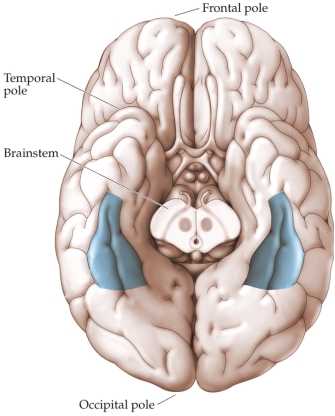 Refer to the figure.   A person who sustained damage to the shaded regions in the figure would be most likely experience which of the following events? A)  When the person's partner comes and talks with them at the hospital, they do not recognize their partner. B)  When the person reaches to turn on a light in a dark room, they feel the switch, but they keep searching because they don't recognize it as the light switch. C)  A botanist recognizes their partner and children through the window of their hospital room, but can no longer differentiate between the different flowers in the bouquets in the room. D)  When looking through a family photo album with their adult daughter, the person asks who the people in the photos are.