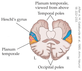Refer to the figure.   Consider a patient whose brain scan resembles the figure. Which statement represents the most likely diagnosis? A)  The left planum temporale is the same size as the right, so the patient is likely dyslexic. B)  Heschl's gyrus is much smaller than the planum temporale, so the patient is likely dyslexic. C)  The figure shows that there are more neurons in the left than the right planum temporale, thus this patient likely does not have dyslexia. D)  The planum temporale is larger than Heschl's gyrus, thus this patient likely does not have dyslexia.