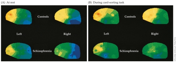 Refer to the figure showing PET scans of twins in which one is affected with schizophrenia and one is not.   The activation patterns suggest _______ activation in the frontal cortex of the affected twin, both at rest and during the Wisconsin Cart Sorting Test. A)  less B)  more C)  equal D)  no