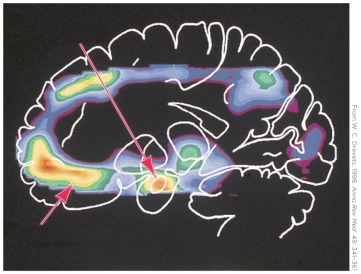 Refer to the figure.   Compared with the data from controls, PET scans of patients with depression show A)  decreases in blood flow in the prefrontal cortex and amygdala. B)  increases in blood flow in the prefrontal cortex and amygdala. C)  increases in blood flow in the prefrontal, temporal, and parietal cortexes. D)  hypofrontality.