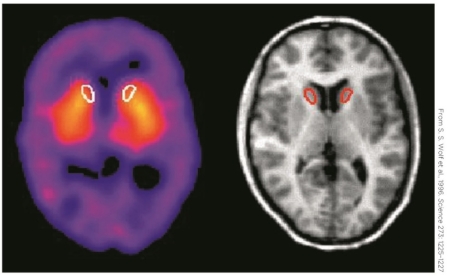 Refer to the figure showing PET scans of patients with Tourette's syndrome.   These scans show greater density of dopamine receptors in the A)  basal ganglia. B)  limbic system. C)  cerebellum. D)  spinal cord.