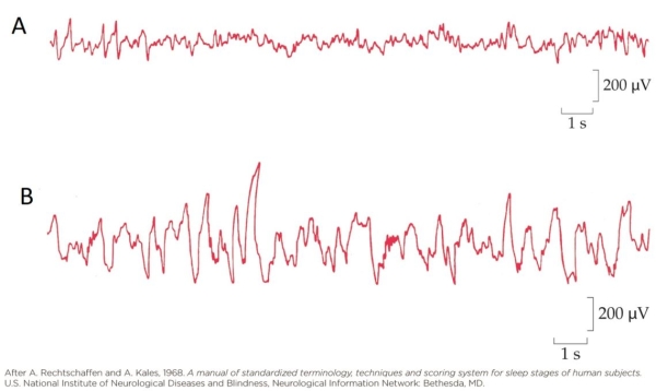 Refer to the figure, which show the EEG patterns recording during two of the different stages of sleep.   The EEG pattern that represents REM sleep is most likely pattern _______.<div style=padding-top: 35px> 