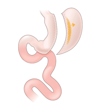 Refer to the figure.   A patient elected to have the surgery illustrated in the figure to treat their type II diabetes. What kind of surgery did the patient choose? A)  Roux-en-Y gastric bypass surgery to reduce nutrient absorption and ghrelin secretion B)  Sleeve gastrectomy to reduce nutrient absorption and ghrelin secretion C)  Colectomy to reduce nutrient absorption. D)  Gastrectomy to improve the gut microbiota