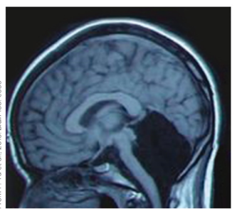 Refer to the figure.   The individual depicted in the figure A)  had their prefrontal cortex removed due to seizures, and they now have trouble deciding how to move. B)  had their cerebellum removed due to seizures, and they now have trouble executing smooth movements. C)  was born without a cerebellum, but because of neuroplasticity, they have no motor deficiencies. D)  was born without a prefrontal cortex, but because of neuroplasticity, they have no difficulty deciding to move.