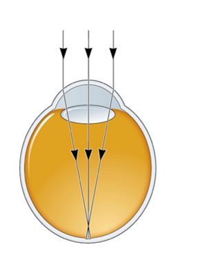 Refer to the figure.   An individual whose vision is illustrated by the figure A)  has normal vision. B)  has amblyopia. C)  has myopia. D)  is farsighted.