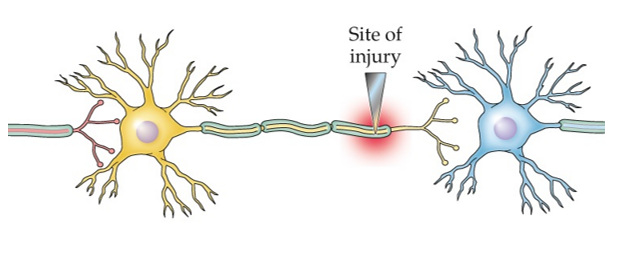 Refer to the figure.   What is likely to happen to the peripheral neurons in the figure? A)  The injured neuron will undergo retrograde degeneration, and the presynaptic and postsynaptic neurons will undergo transneuronal degeneration. B)  The injured neuron will degenerate, and the presynaptic and postsynaptic neurons will likely be unaffected. C)  The injured neuron will undergo Wallerian degeneration, and the presynaptic and postsynaptic neurons will likely undergo transneuronal degeneration. D)  The presynaptic neuron will remain unchanged, the injured neuron will undergo anterograde degeneration and likely regenerate axons, which will be drawn to cell adhesion molecules released by the postsynaptic neuron.