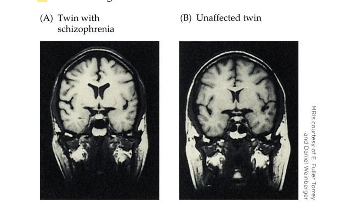 Refer to the figure.   A researcher who is studying schizophrenia examines the images above. What sort of study is this researcher conducting? A)  A study to determine causality B)  A somatic intervention C)  A behavioral intervention D)  A correlational study