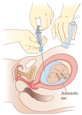 <strong>Refer to the figure.   The figure illustrates _______, which is used to test for fetal abnormalities.</strong> A) quickening B) amniocentesis C) the Bradley method D) chorionic villus sampling E) cell-free fetal DNA analysis <div style=padding-top: 35px> 