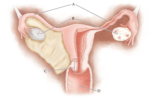Refer to the figure   The correct labels for the lettered structures are A)  A: fimbria; B: ovaries; C: vagina; D: rectum B)  A: oviducts; B: ovaries; C: cervix; D: vagina C)  A: oviducts; B: fibroids; C: endometrium; D: perimetrium D)  A: fimbria; B: fibroids; C: vagina; D: cervix E)  A: endometrium; B: fimbria; C: cervix; D: rectum