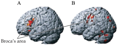Refer to the image.    The figure shows the pattern of brain activation during a language task. Which brain (A or B) shows abnormal activation? What could have caused this abnormality, and what would this do to language capacity in an individual?