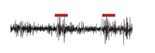   In the cortical EEG reading above, what would you expect the activity of a neuron simultaneously recorded in the locus coeruleus to be at the areas indicated by the red horizontal bar? A)  a corresponding decrease in locus coeruleus firing B)  a corresponding increase in locus coeruleus firing C)  no change in locus coeruleus firing