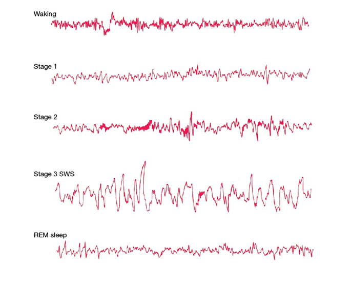 Use the following to answer questions : Refer to the figure below.    -The appearance of vertex spikes characterizes the transition from a A)  waking stage to a light sleep. B)  light sleep to a moderately heavy sleep. C)  heavy sleep to a state of vivid dreaming. D)  state of disordered dreaming to a light sleep.