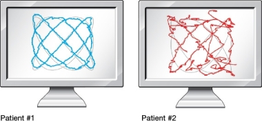 Refer to the figure below.   The line on each screen reflects the eye movements of a patient tracking a moving cursor. Which of the following statements is most likely to be true? A)  Patient 1 has schizophrenia but Patient 2 does not. B)  Patient 2 has schizophrenia but Patient 1 does not. C)  Patient 1 has a higher risk for schizophrenia than Patient 2. D)  Patient 2 has a higher risk for schizophrenia than Patient 1.