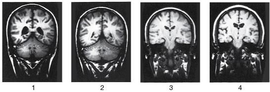 Refer to the figure below.   Which of the MRI images above are most likely to be scans of people with schizophrenia? A)  1 and 2 B)  1 and 4 C)  2 and 3 D)  3 and 4