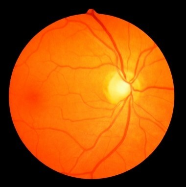 Refer to the figure.   Eye doctors use an instrument called an ophthalmoscope to look at the _______ of their patients' eyes, as seen in the image. A)  cornea B)  iris C)  lens D)  focal point E)  fundus