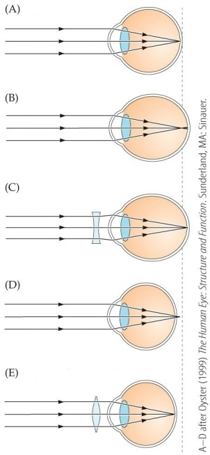 Refer to the figure.   Which part of the figure depicts hyperopia without correction? A)  A B)  B C)  C D)  D E)  E