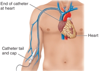 The medical device shown in the illustration is a   A)  CVC B)  Urinary catheter C)  Postoperative drain D)  PICC line