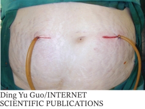 <strong>The medical device shown in the illustration is a  </strong> A) Urinary catheter B) Postoperative drain C) PICC line D) CVC <div style=padding-top: 35px> 