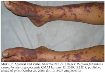The medical condition in the photo is   A)  Shock B)  Disseminated intravascular coagulation C)  Peripheral vein thrombosis D)  Adult coagulation syndrome