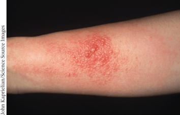 The photo below shows a patient suffering from _________ which is a type _____ hypersensitivity.   A)  the Arthus reaction; III B)  Lupus; II C)  contact dermatitis; IV D)  urticaria; I
