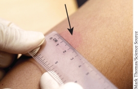The indicated skin lesion denoting a positive Mantoux Test result is known as a(n)  ______________.   A)  bulla B)  hive C)  induration D)  papule