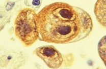 This micrograph of virally-infected cells demonstrates the cytopathic effect known as ________.   A)  nucleomegaly B)  inclusion bodies C)  syncytium formation D)  cellular rounding