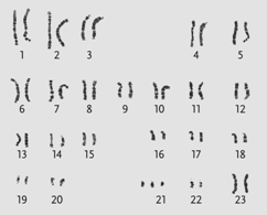 <strong> Figure 13.5a Which genetic condition is revealed in the karyotype display shown in the accompanying figure? </strong> A)Turner syndrome B)Down syndrome C)cri-du-chat D)Triple-X syndrome E)Klinefelter syndrome
