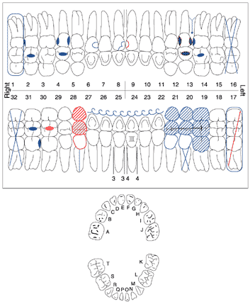   Using the chart above, what is charted on Tooth #4? A)  MOD B)  O C)  Missing D)  None of the above