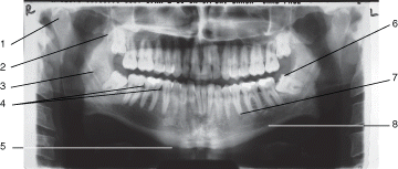 Utilizing the panoramic radiograph, identify the following mandibular landmarks by abbreviations.      A. (ac)  B. (bom)  C. (c)  D. (cor)  E. (eor)  F. (mc)  G. (mf)  H. (s)  